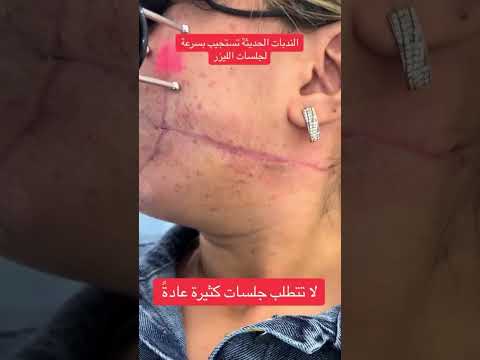 ازالة الندبات بالليزر فركشينال ليزر 2