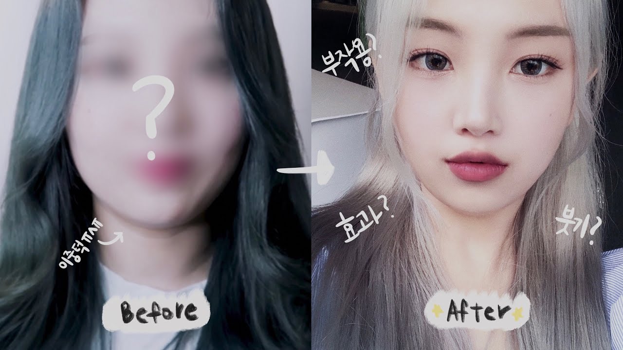날씬한 얼굴을 위한 강남얼굴윤곽주사 리뷰/합리적인 얼굴지방분해 주사비용!! <갤럼 주사 1회차> 5