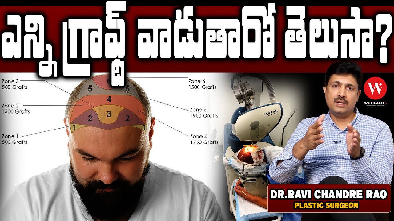 Brupal Raviahir ఎన్ని గ్రాఫ్ట్ వాడుతారో తెలుసా? Hair Transplant Density Graft Count ...