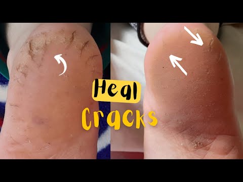 How to heal cracked heels the natural way