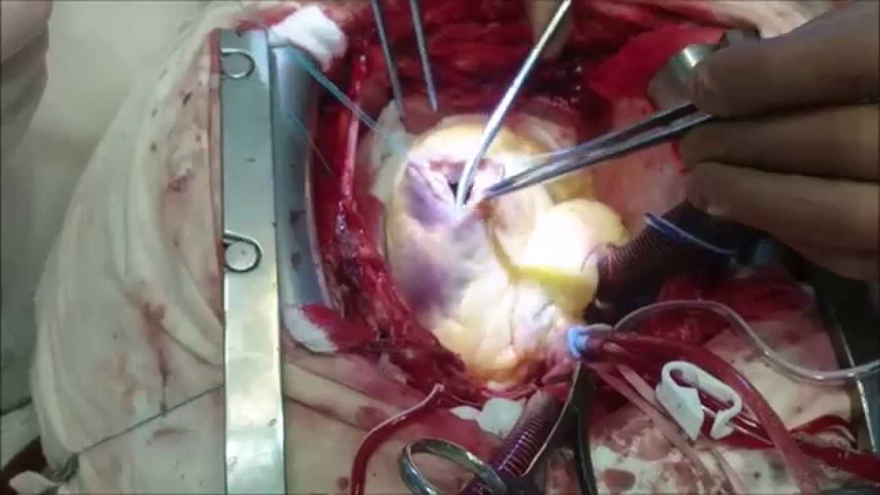 Операция по удалению аневризмы левого желудочка сердца. Ульяновск