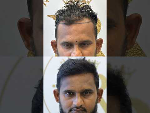 Beard and Hair Transplant Results #beardtransplant #hairtransplant #beard #shorts