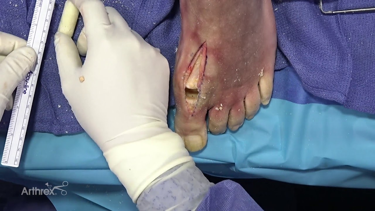 orthopedic disability MTP Revision With Arthrex Cannulated Revision Bone Dowel