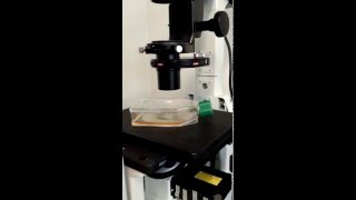 Cancer cells under fluorescent microscope