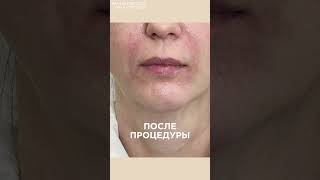 Провели коррекцию подбородка плотным филлером на основе гиалуроновой кислоты 1.0 мл.