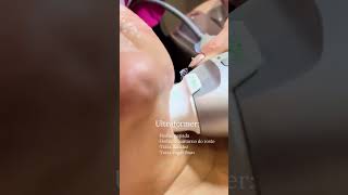 Ultraformer melhor tratamento para estimular colágeno e elastina #esteticaavancada #cuidadoscomapele