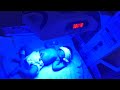 Today a baby came from outside whose bilirubin was high | We put him to phototherapy