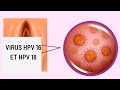 Virus hpv 16 et hpv 18