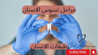 مراحل تسوس الاسنان / طبقات الاسنان