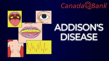 Thumbnail of Addison Disease