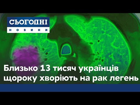 Онкология не приговор: 13 тысячам украинцев ежегодно диагностируют рак легких