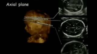 Practical Approaches to Fetal CNS Evaluation Fetal Cns