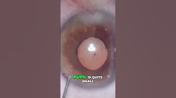 Eye Surgery Unsticking the iris