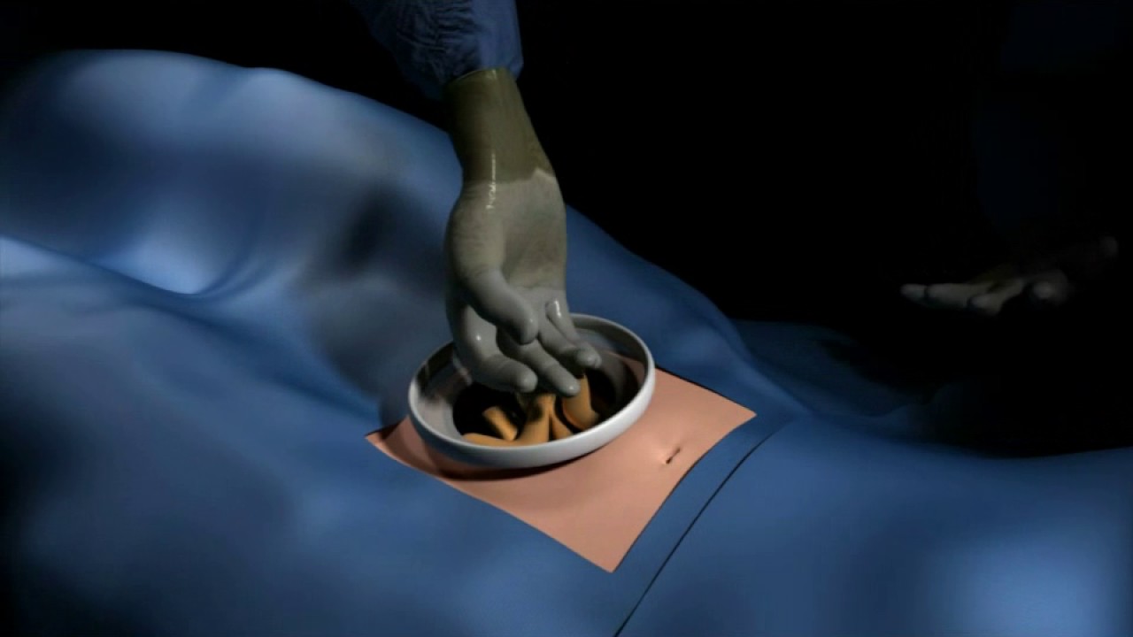 GelPort Laparoscopic System Setup Guide YouTube