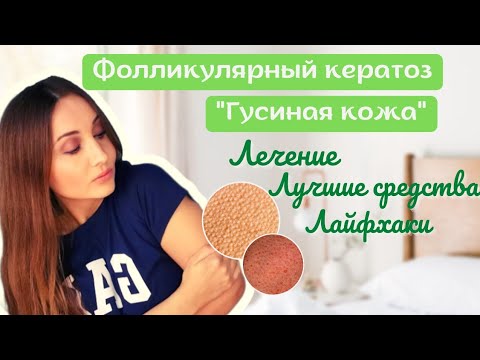 🦆ГУСИНАЯ КОЖА: Как избавиться?ФОЛЛИКУЛЯРНЫЙ ГИПЕРКЕРАТОЗ на руках, ногах,лице, попе: Фото, Лечение.