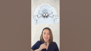 What is miniscrew assisted rapid palatal expansion(MARPE)? #marpe #orthodontics