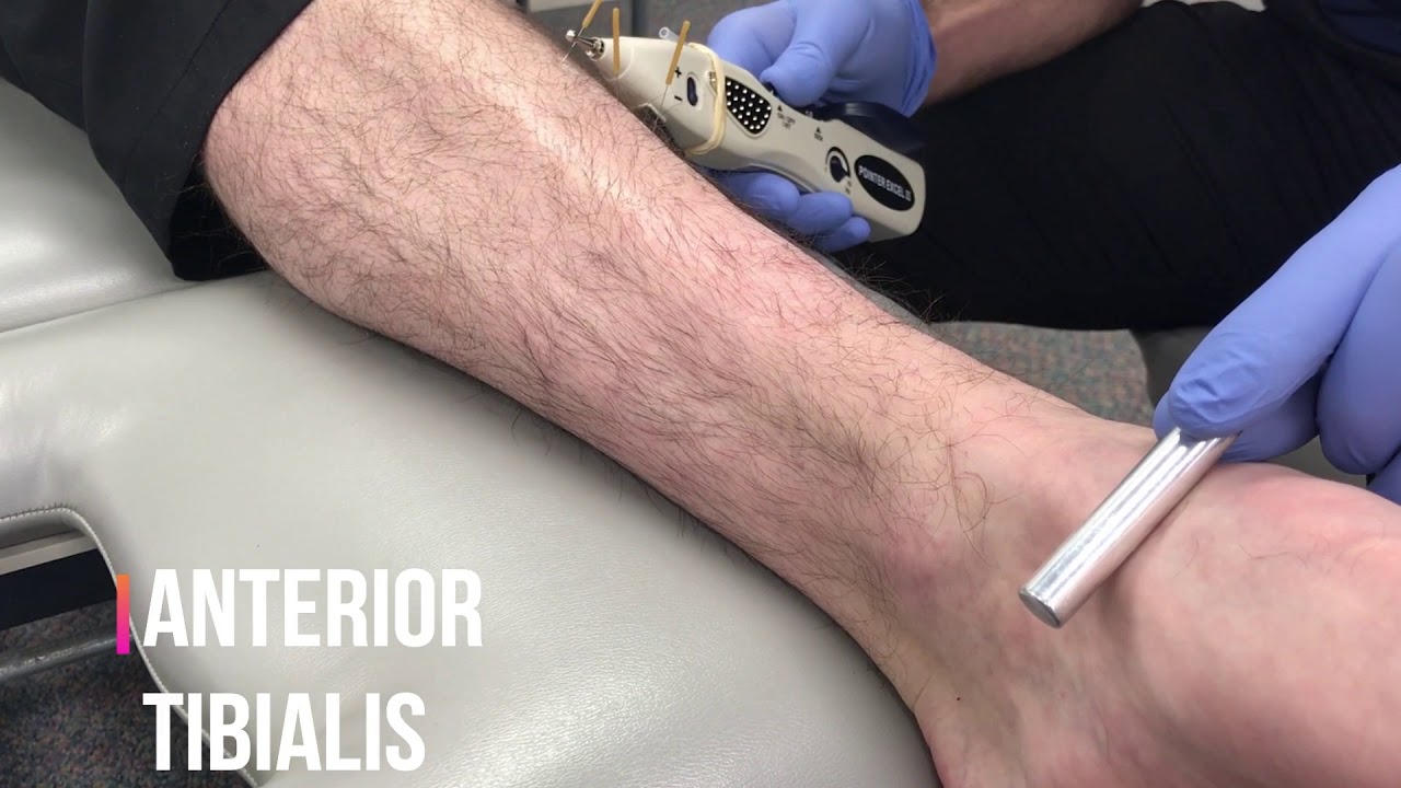 Did you know we offer dry needling with electrical stimulation? When  coupled with dry needling, e-stim helps accelerate the pain relief process  on a, By 903 Physical Therapy