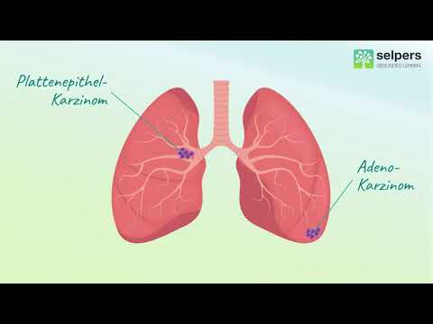 Lage des Lungentumors (Lungenkrebs verstehen)