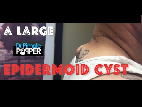 Removal Of A Large Epidermoid Cyst, Upper Back