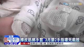 20150225中天新聞　怕嬰抓臉　3月嬰橡皮筋包手2指壞死