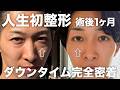【クマ取り】いくら？痛い？ダウンタイム全部公開します｜整形ビフォーアフター