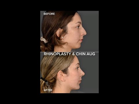 Video thumbnail: Rhinoplasty + Chin Augmentation · Rady Rahban, MD
