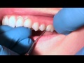 Exploring posterior teeth