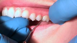 Exploring Posterior Teeth