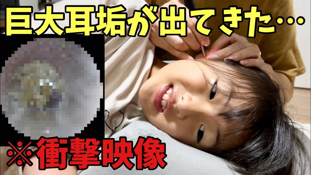 耳掃除】カメラ付き耳かきでヤバすぎる耳垢が出てきた！これでスッキリ