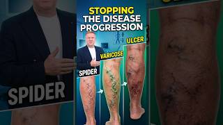 Stages of Varicose Veins: From Spider Veins to Venous Ulcers