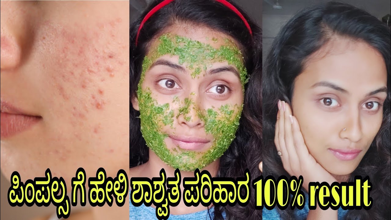 best natural ಫೇಸ್ ಪ್ಯಾಕ್ ಮುಖದಲ್ಲಿನ ಎಂಥ ಮೊಡವೆಯಾದರು ಮಾಯ neem face pack to remove pimples
