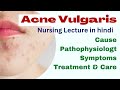 Acne vulgaris lecture  msn  nursing lecture in hindi  cause symptoms treatment pathophysiology