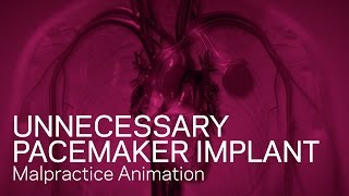 Pacemaker - Medical Device Animation