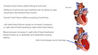 Pathophysiology: Heart Failure