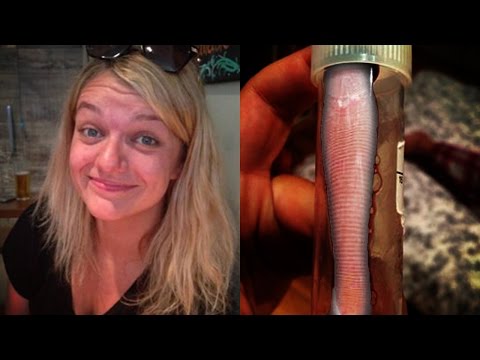 Video: An Asian Leech Lived In The Nose Of An Englishwoman For A Month - - Alternative View