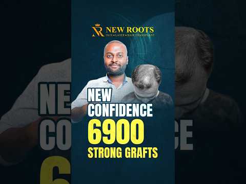 6900 Grafts Hair Transplant in Siliguri | Cost & Best Results #hairtransplant #shorts
