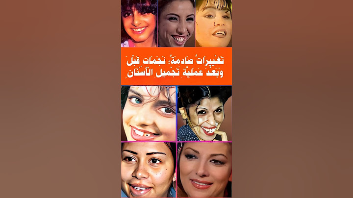 تغييرات صادمة قبل وبعد عمليات تجميل الأسنان