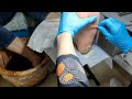 Pedicure : Dead skin removal and Cracked heels treatment by Professional technician.