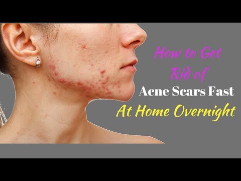 How to Get Rid of Acne Scars Fast at Home Overnight