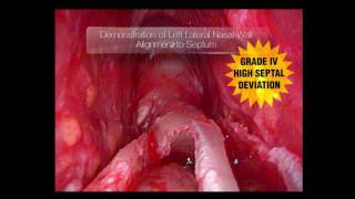 Download Micro-rhinoplasty - Lateral Osteotomy Video MP3 Micro-rhinoplasty - Lateral Osteotomy