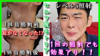 トリアのヒゲ脱毛は1回の照射でも効果あり!!家庭用レーザー脱毛器2回目の照射