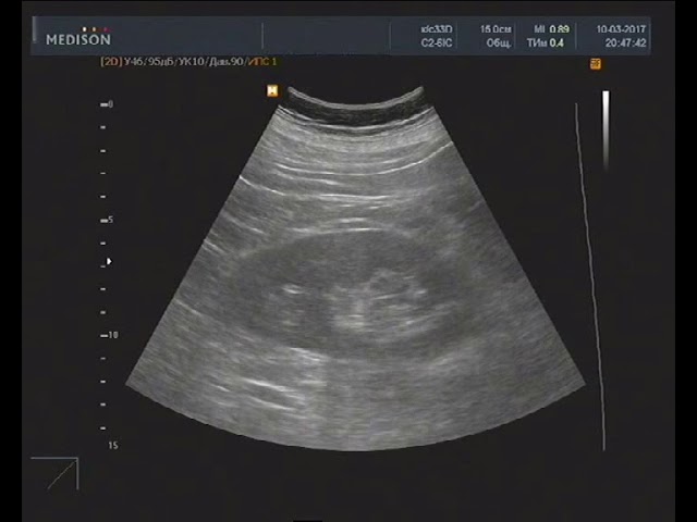 Нефросклероз слева