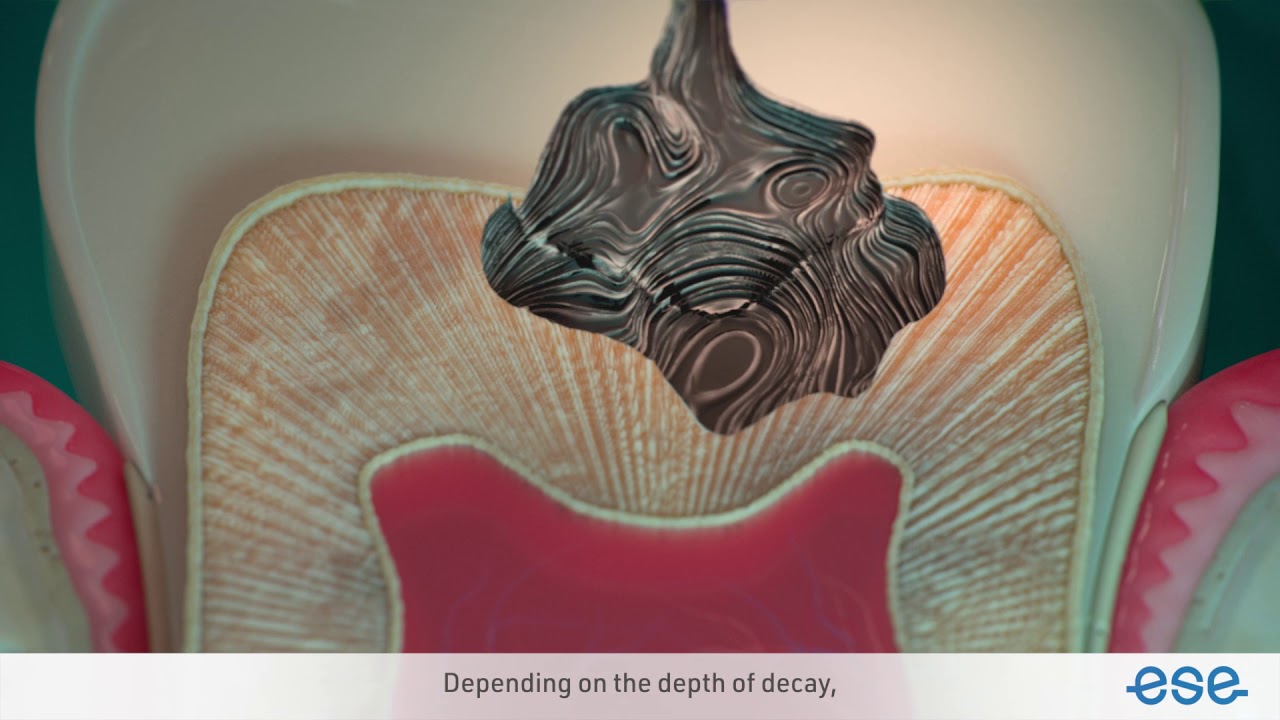 Vital Pulp Treatment - YouTube