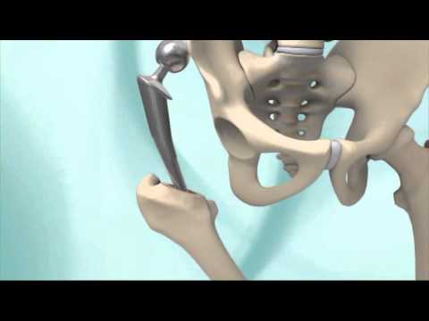 Hip Replacement Surgery