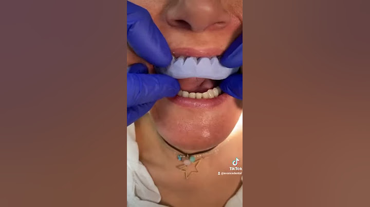 ¡DISEÑO DE SONRISA! Antes de ponerte carillas dentales comprueba como se VEN #Shorts