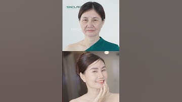 CĂNG DA MẶT NỘI SOI SMAS - TRẺ ĐẸP NGAY SAU 60 PHÚT