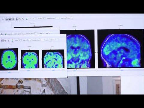 Video: Kdo najverjetneje zboli za alzheimerjevo boleznijo?