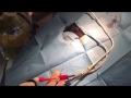 Dialysis Ablation Of A Catheter