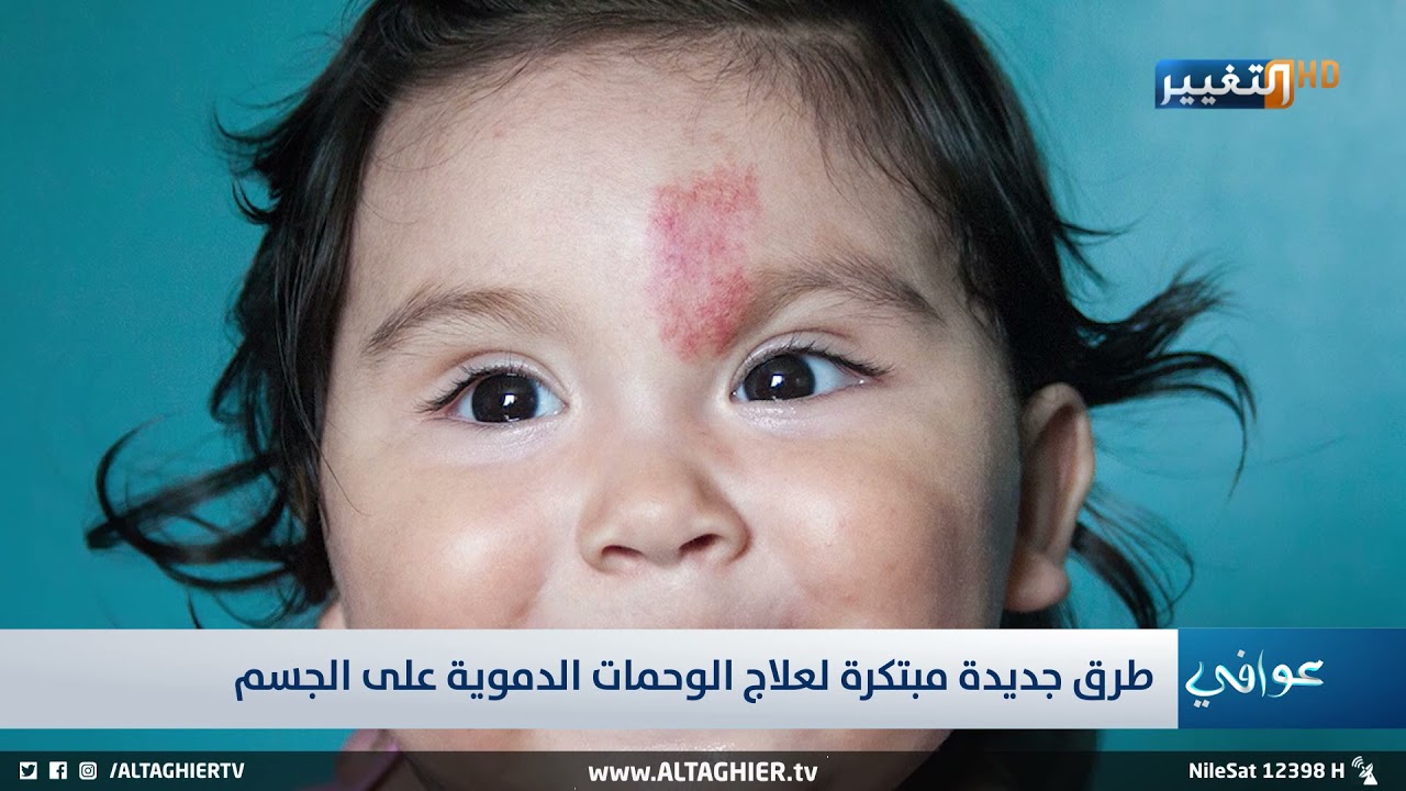 طرق جديدة ومبتكرة لعلاج الوحمات الدموية