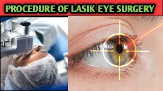 Things To Know About Lasik Eye Surgery.